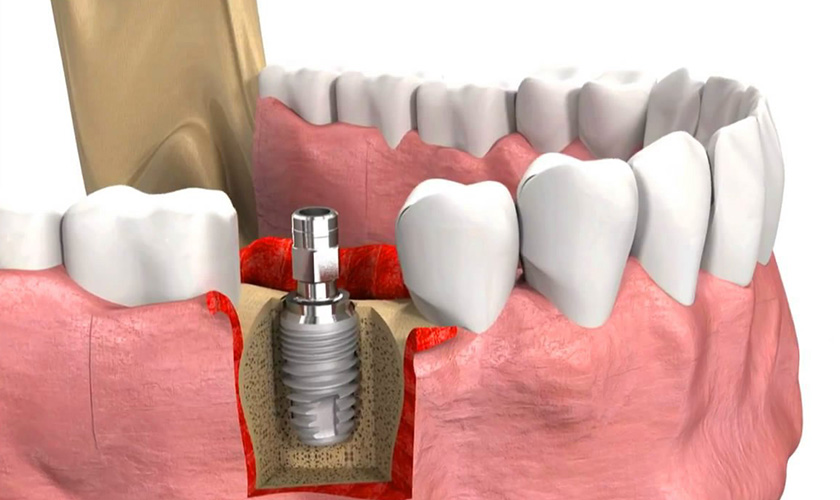 Nâng xoang hàm ghép xương và cấy ghép implant