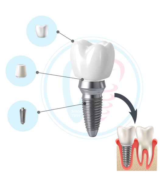 Cấu tạo răng Implant gồm 3 phần