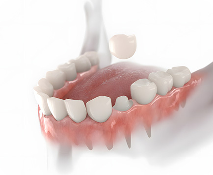 Bọc răng sứ Dịch vụ: Bọc răng sứ