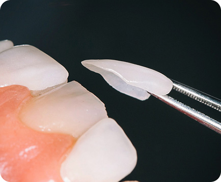 Dán sứ venner Dịch vụ: Dán sứ venner