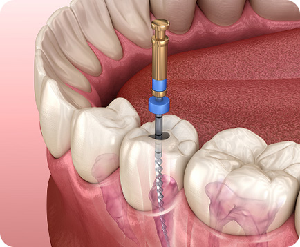 Điều trị tủy răng Dịch vụ: Điều trị tủy răng