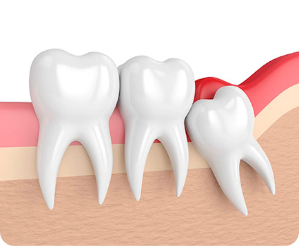 Nhổ răng khôn Dịch vụ: Nhổ răng khôn