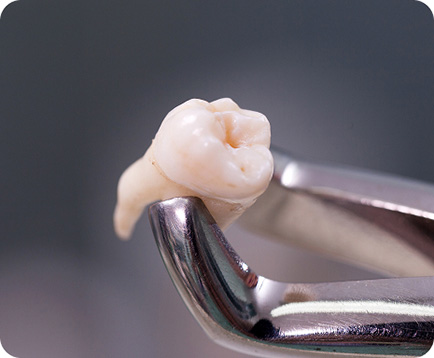 Nhổ răng Dịch vụ: Nhổ răng