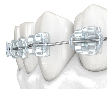 Niềng răng mắc cài sứ Dịch vụ: Niềng răng mắc cài sứ