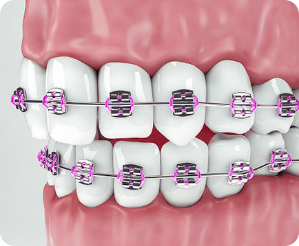 Niềng răng mắc kim loại Dịch vụ: Niềng răng mắc kim loại