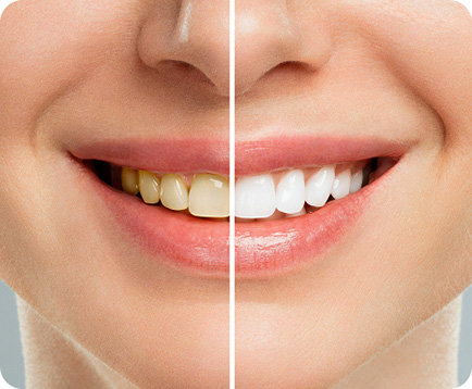 Tẩy trắng răng Dịch vụ: Tẩy trắng răng