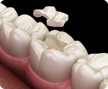 Trám răng Dịch vụ: Trám răng