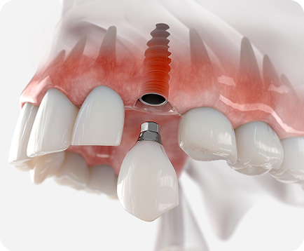 Trồng răng Implant 1 răng Dịch vụ: Trồng răng Implant 1 răng