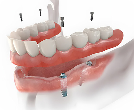 Trồng răng Implant cho Việt Kiều Dịch vụ: Trồng răng Implant cho Việt Kiều