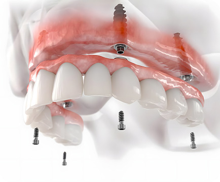 Trồng răng Implant toàn hàm Dịch vụ: Trồng răng Implant toàn hàm