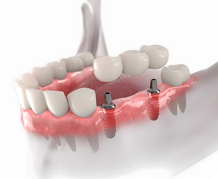 Trồng răng Implant vài răng Dịch vụ: Trồng răng Implant vài răng