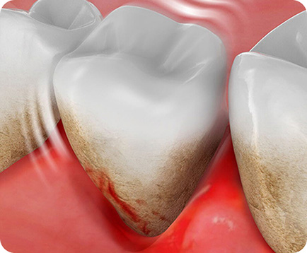 Viêm nướu nha chu Dịch vụ: Viêm nướu nha chu