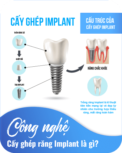 Cấy ghép răng Implant là gì?