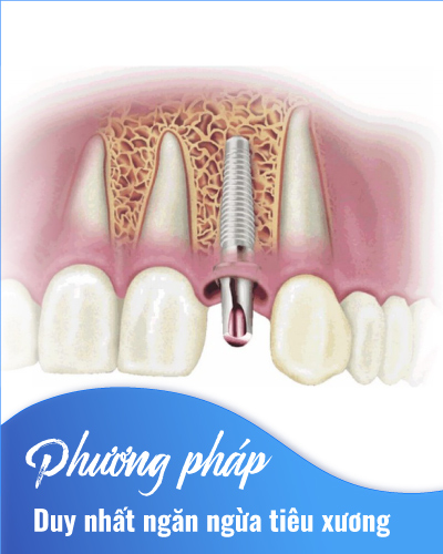 Phương pháp DUY NHẤT ngăn ngừa tiêu xương