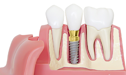 Cấy ghép Implant