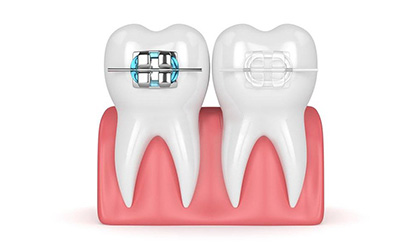 Niềng răng thẩm mỹ