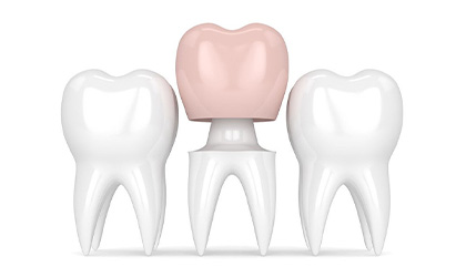 Răng sứ thẩm mỹ
