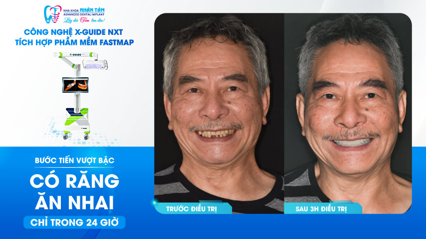 Hình: Ưu điểm vượt trội của cấy ghép implant