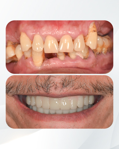 Bước 4 Hình: Bước 4