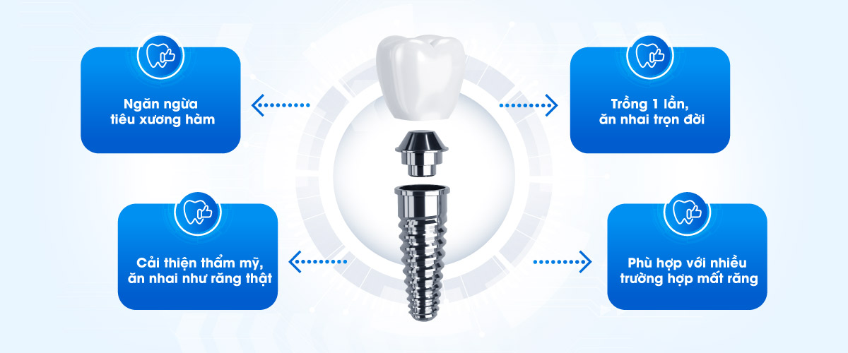 trồng răng implant Hình: trồng răng implant