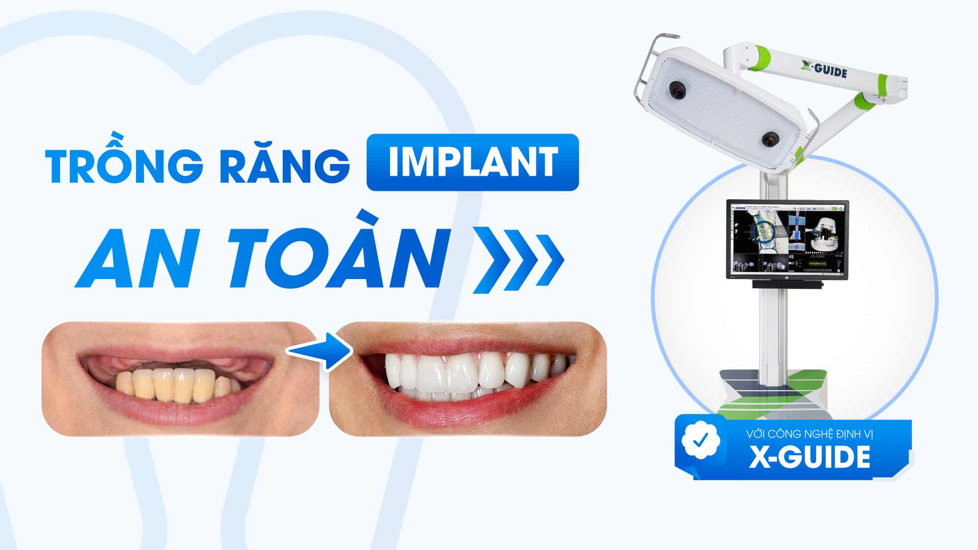 Hình: x-guide –dẫn đầu xu hướng công nghệ trong cấy ghép implant