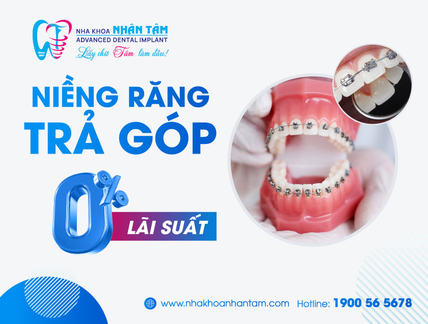 Chương trình niềng răng trả góp lãi suất 0% tại Nha khoa Nhân Tâm