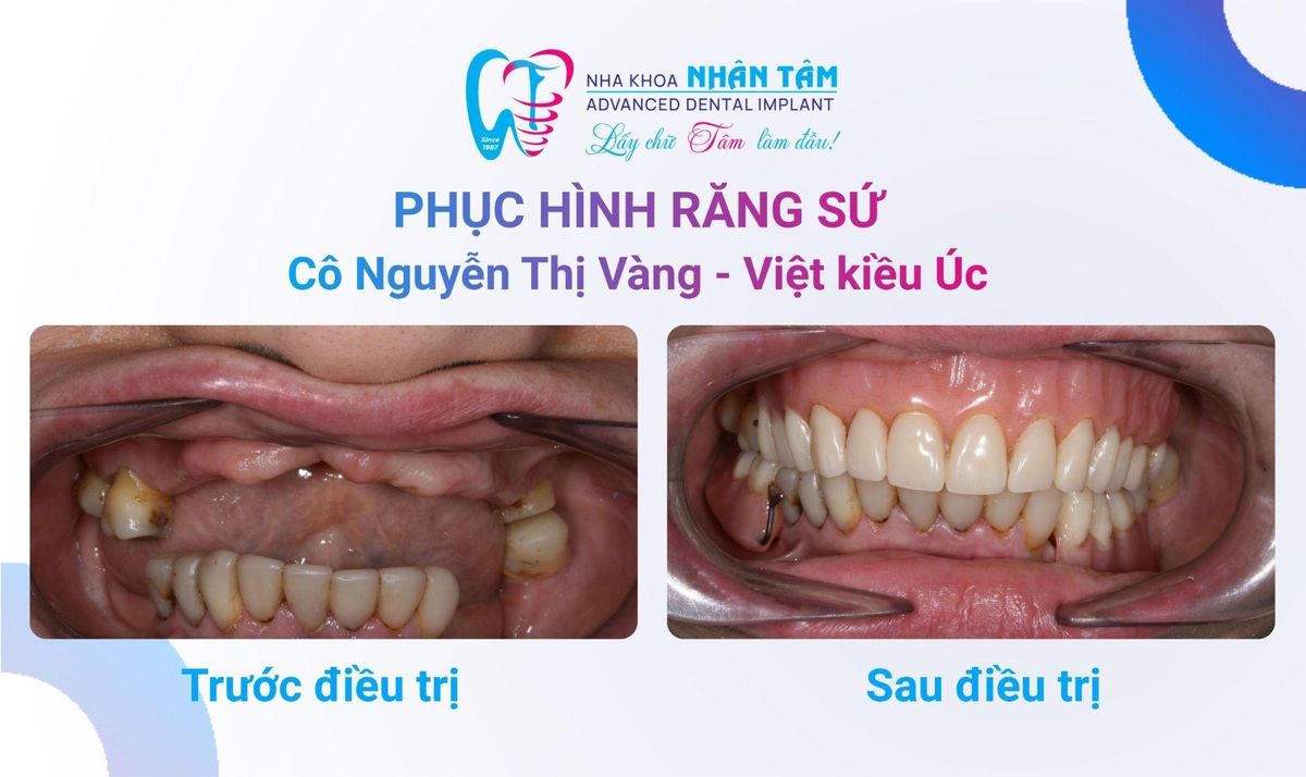 Cô Nguyễn Thị Vàng (Việt kiều Úc) – Câu chuyện khách hàng tại Nha khoa Nhân Tâm Hình: Cô Nguyễn Thị Vàng (Việt kiều Úc) – Câu chuyện khách hàng tại Nha khoa Nhân Tâm