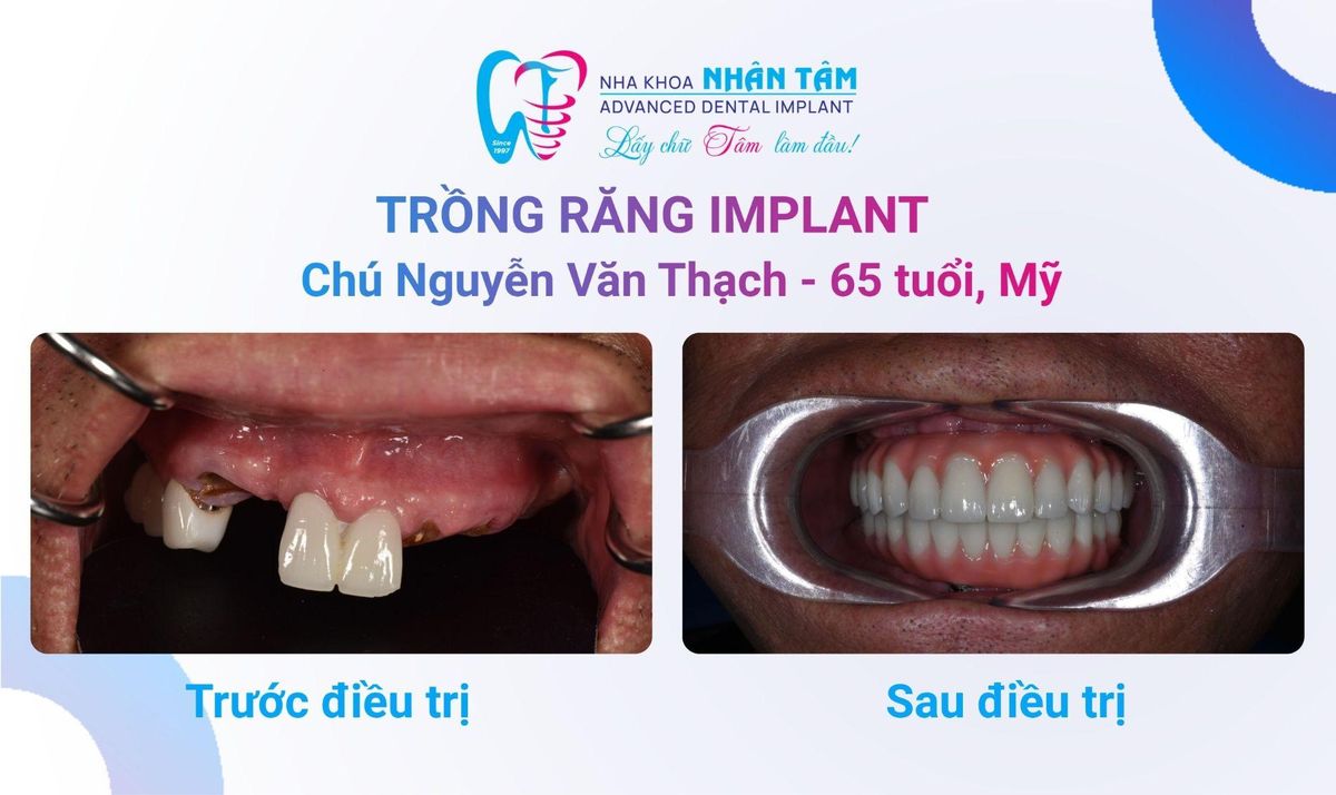 Chú Nguyễn Văn Thạch - 65 tuổi (Việt kiều Mỹ) Hình: Chú Nguyễn Văn Thạch - 65 tuổi (Việt kiều Mỹ)