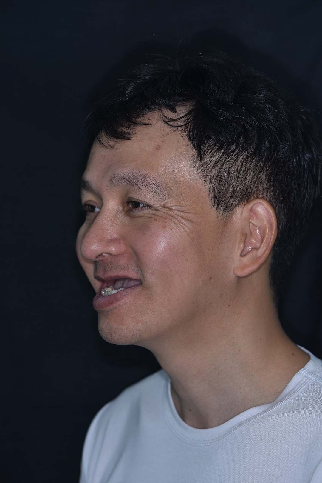 Anh Lê Tuệ Đăng (Việt kiều Mỹ) – tình trạng trước điều trị Hình: Anh Lê Tuệ Đăng (Việt kiều Mỹ) – tình trạng trước điều trị
