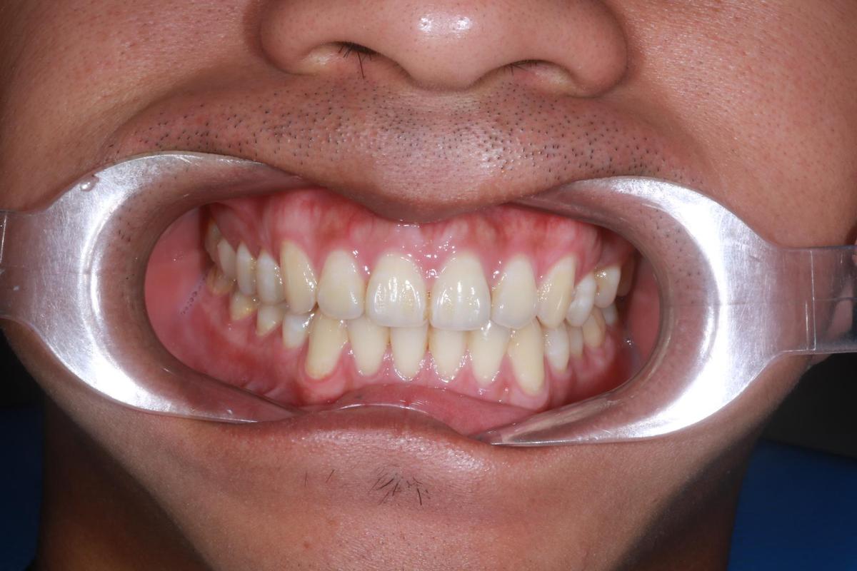 Hình: Anh Nguyễn Đặng Trương Cao – kết quả sau điều trị