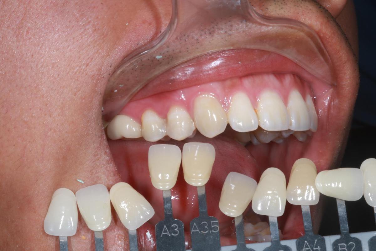Hình: Anh Nguyễn Đặng Trương Cao – quá trình điều trị
