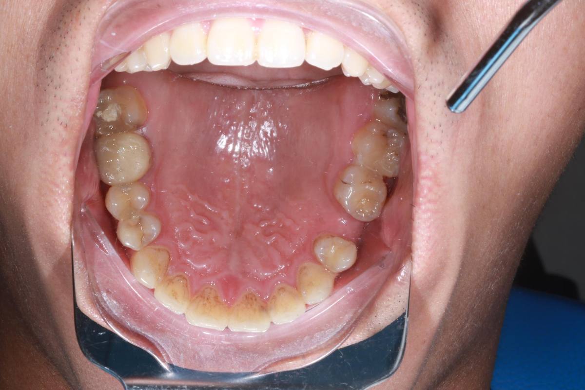 Hình: Anh Nguyễn Đặng Trương Cao – tình trạng trước điều trị