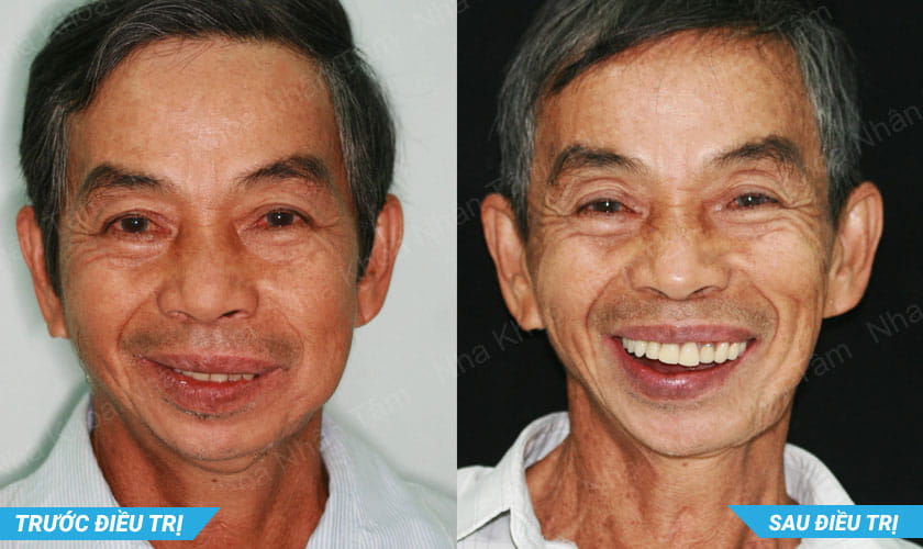 Ca lâm sàng 1
