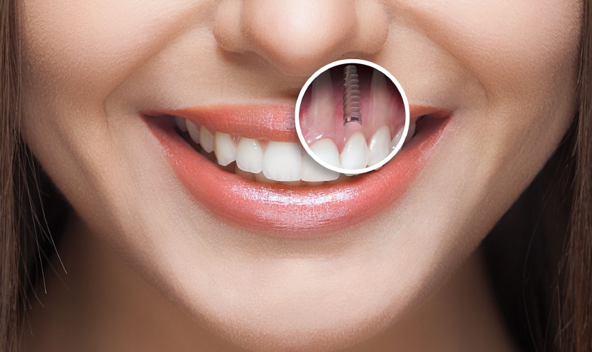 Cấy ghép implant mang đến nhiều ưu điểm vượt trội