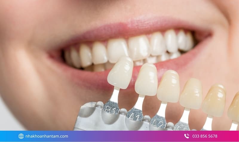 bảng màu răng sứ chuẩn