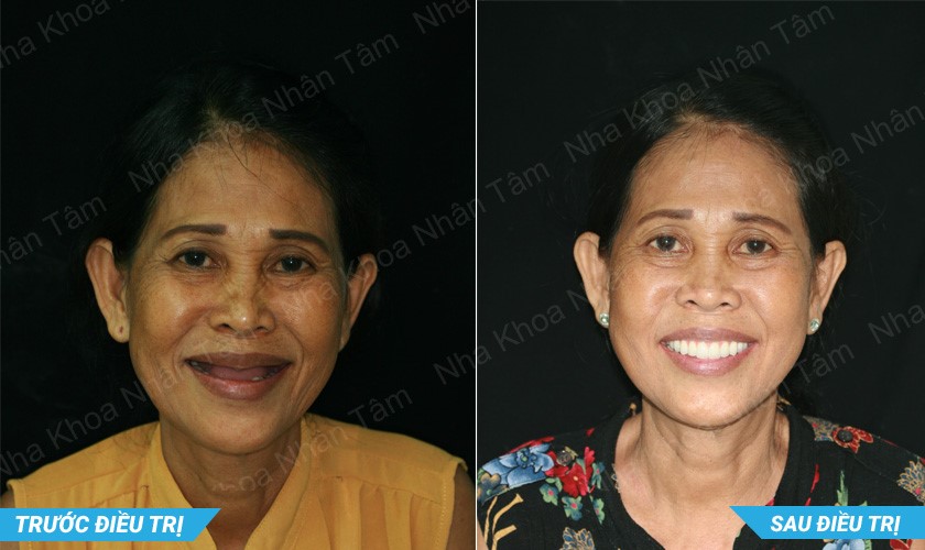 Khách hàng L.N.L trước và sau điều trị tại Nha khoa Nhân Tâm