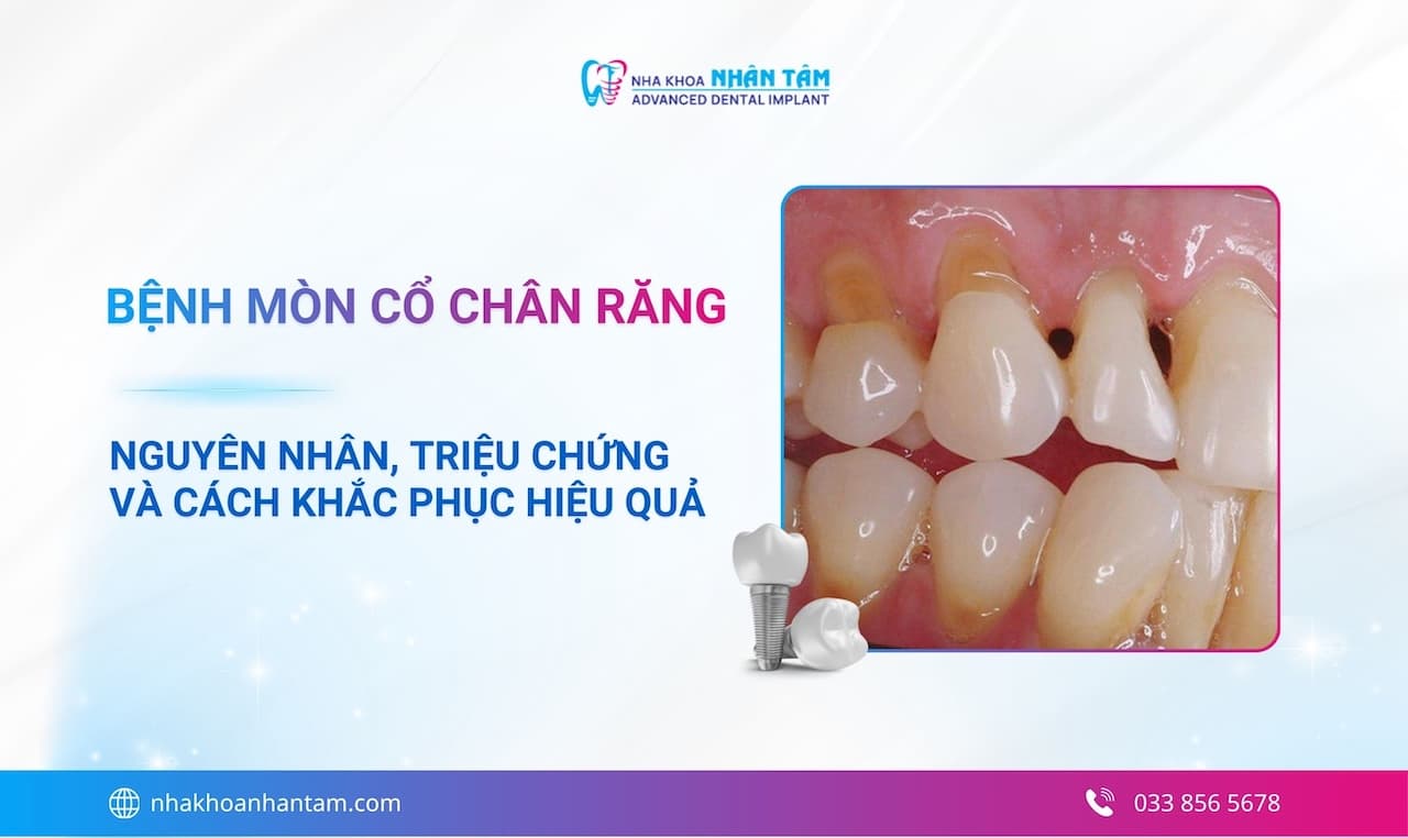 Bệnh mòn cổ chân răng: Nguyên nhân, triệu chứng và cách khắc phục hiệu quả Hình: Bệnh mòn cổ chân răng: Nguyên nhân, triệu chứng và cách khắc phục hiệu quả