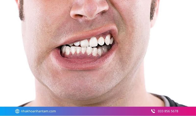 dấu hiệu mòn cổ chân răng