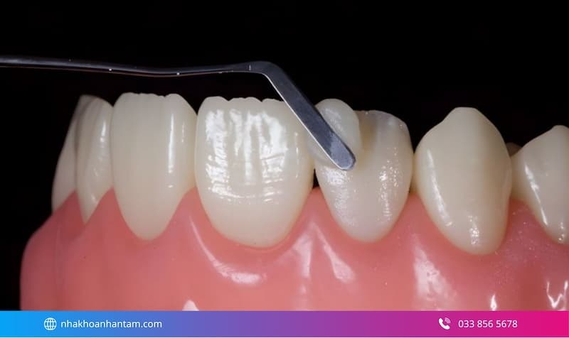 mòn cổ chân răng có nguy hiểm không
