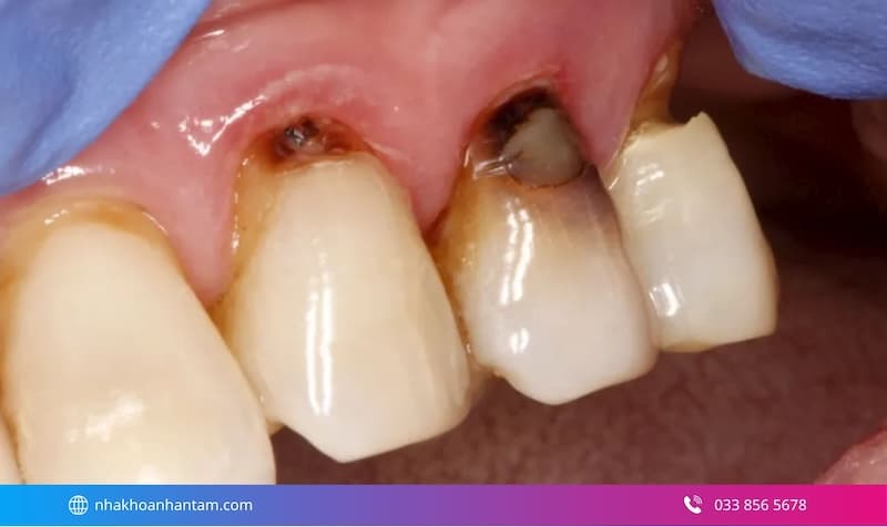 triệu chứng mòn cổ chân răng