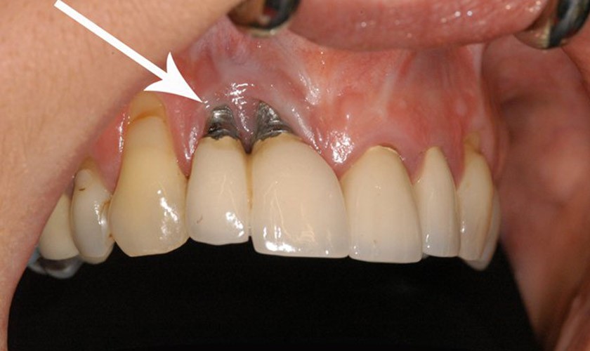Hình: Viêm nhiễm kéo dài làm tiêu xương hàm diện rộng, khiến trụ implant bị lung lay và đối mặt với nguy cơ đào thải