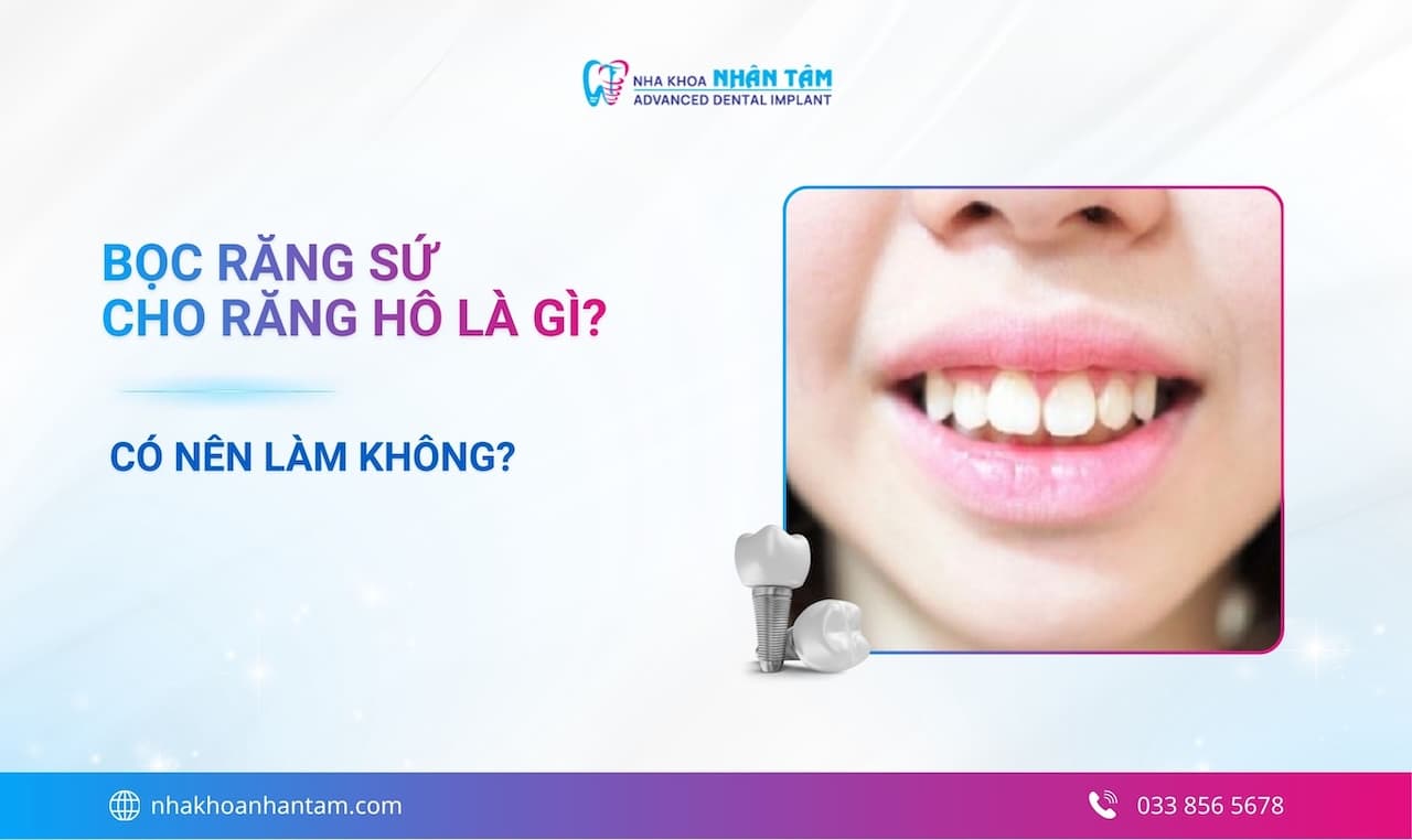 Hình: Bọc răng sứ cho răng hô là gì? Có nên làm không? 