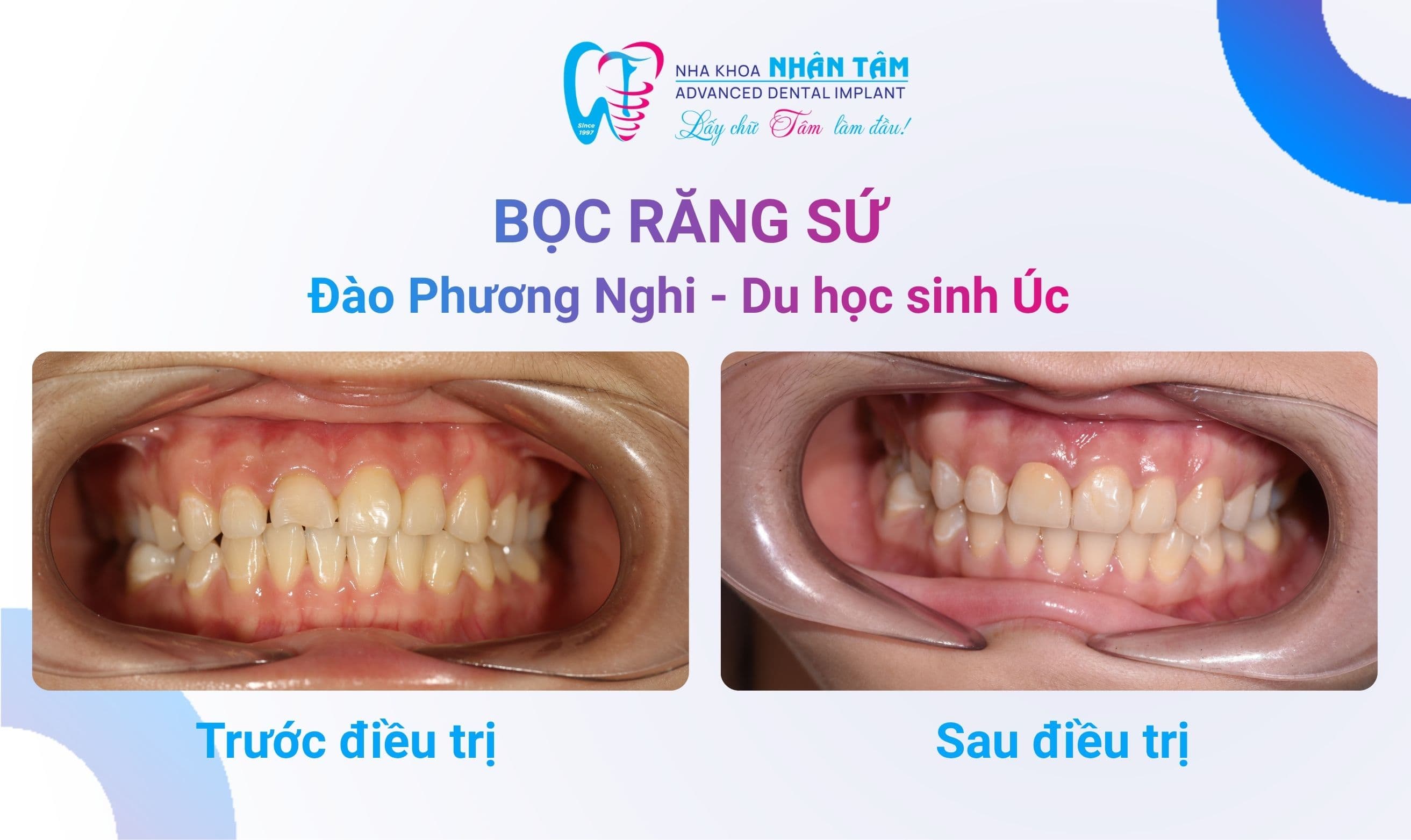 Bọc răng sứ cho răng hư tuỷ - Tạm biệt răng xấu, đổi nụ cười duyên Bọc răng sứ cho răng hư tuỷ - Tạm biệt răng xấu, đổi nụ cười duyên