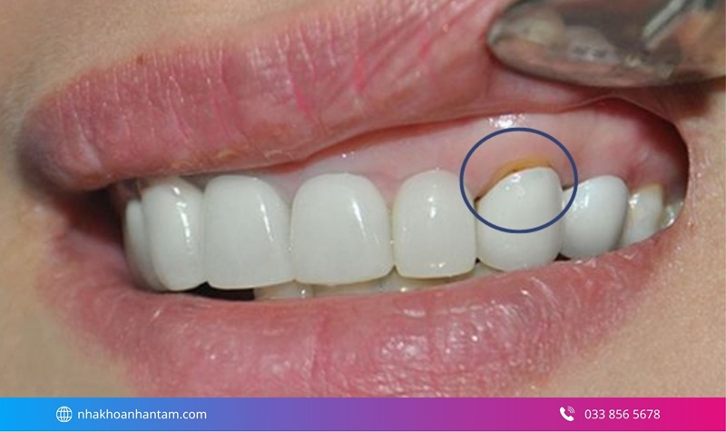 bọc răng sứ có bền không