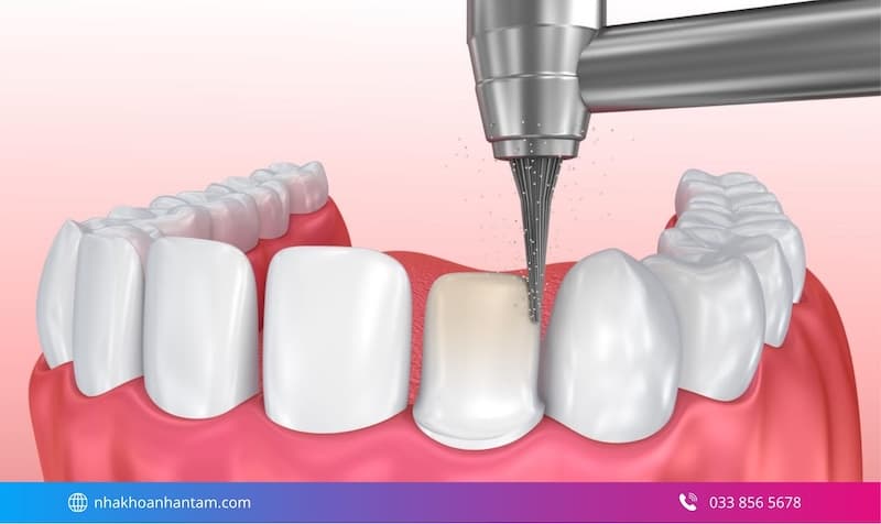 bọc răng sứ có cần gây tê không