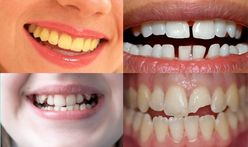 bọc răng sứ có lợi ích gì