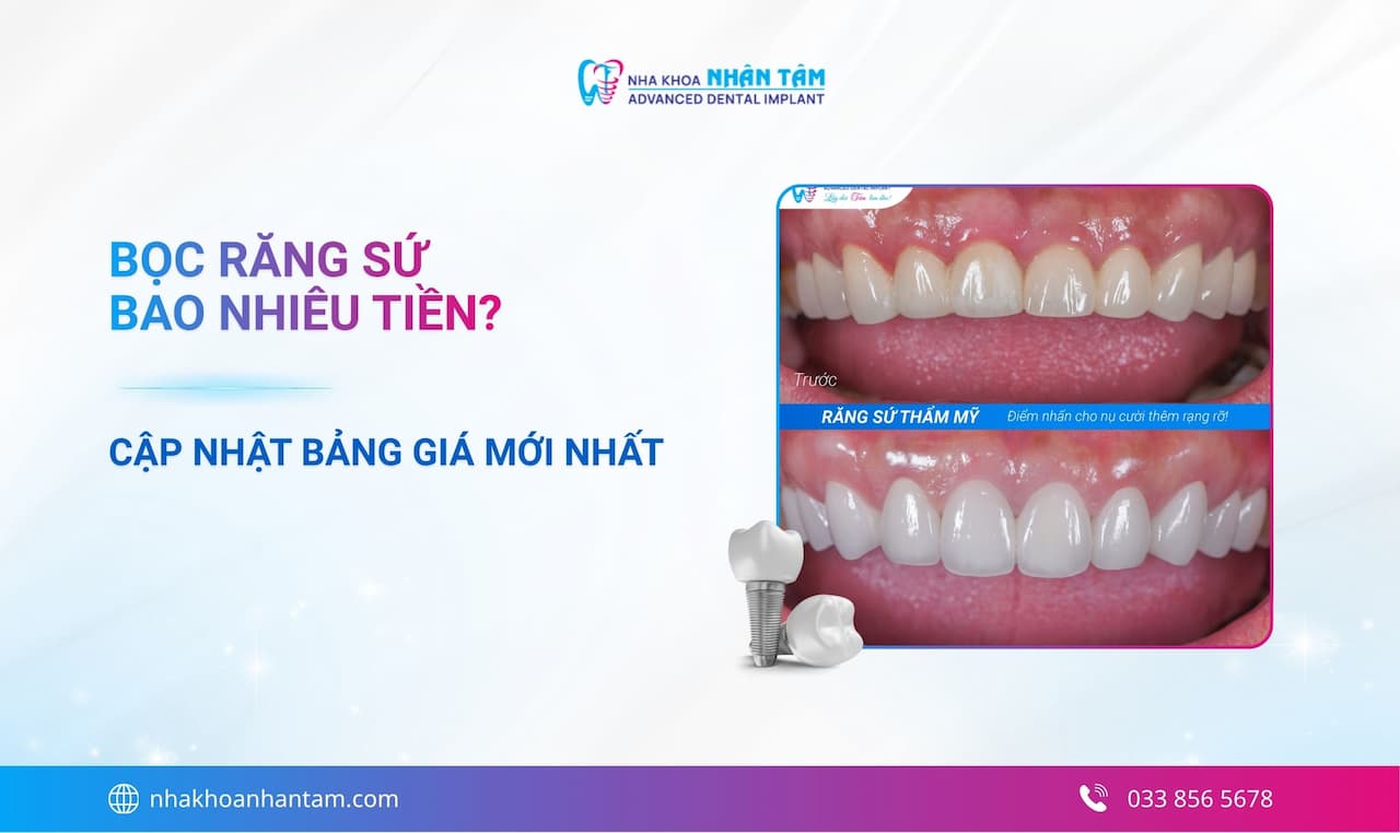 Bọc răng sứ giá bao nhiêu tiền? Cập nhật bảng giá mới nhất
