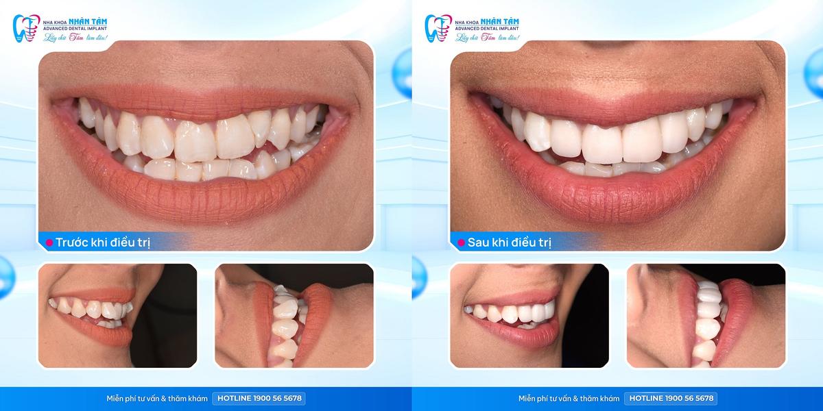 Hình: Mão sứ được chế tác theo hình dáng, kích thước và màu sắc phù hợp với từng răng