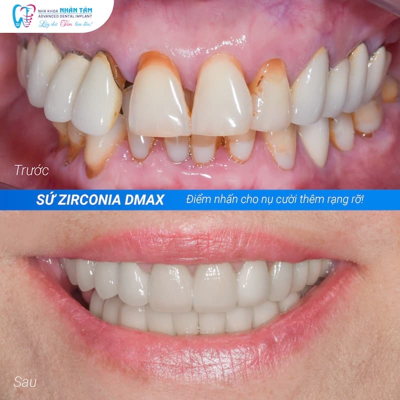bọc răng sứ trả chậm