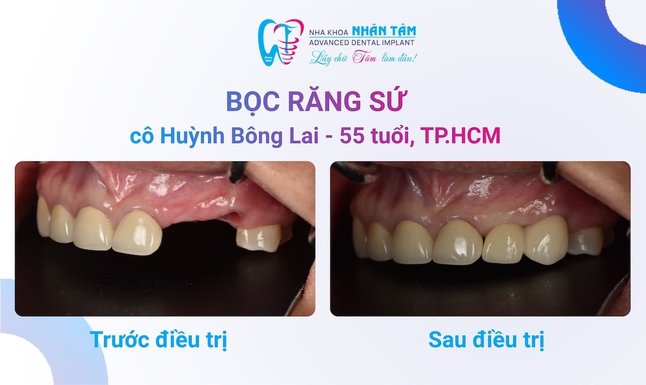 Bọc răng sứ - Xóa tan mọi âu lo Bọc răng sứ - Xóa tan mọi âu lo
